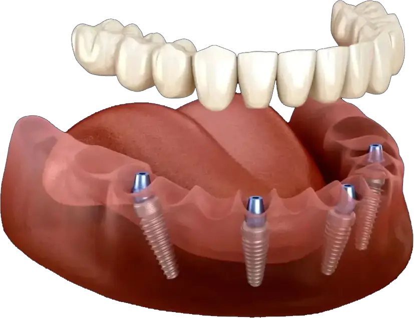 All-On-X dental implant