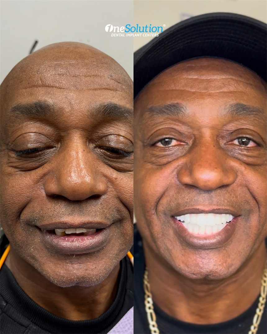 OneSolution® patient before and after dental implants