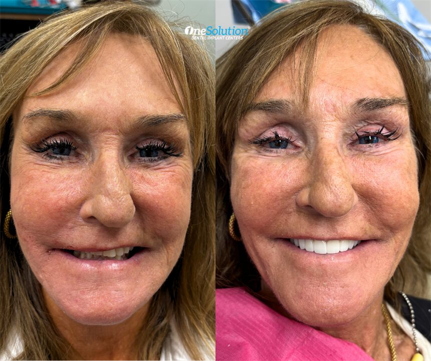OneSolution® patient before and after dental implants