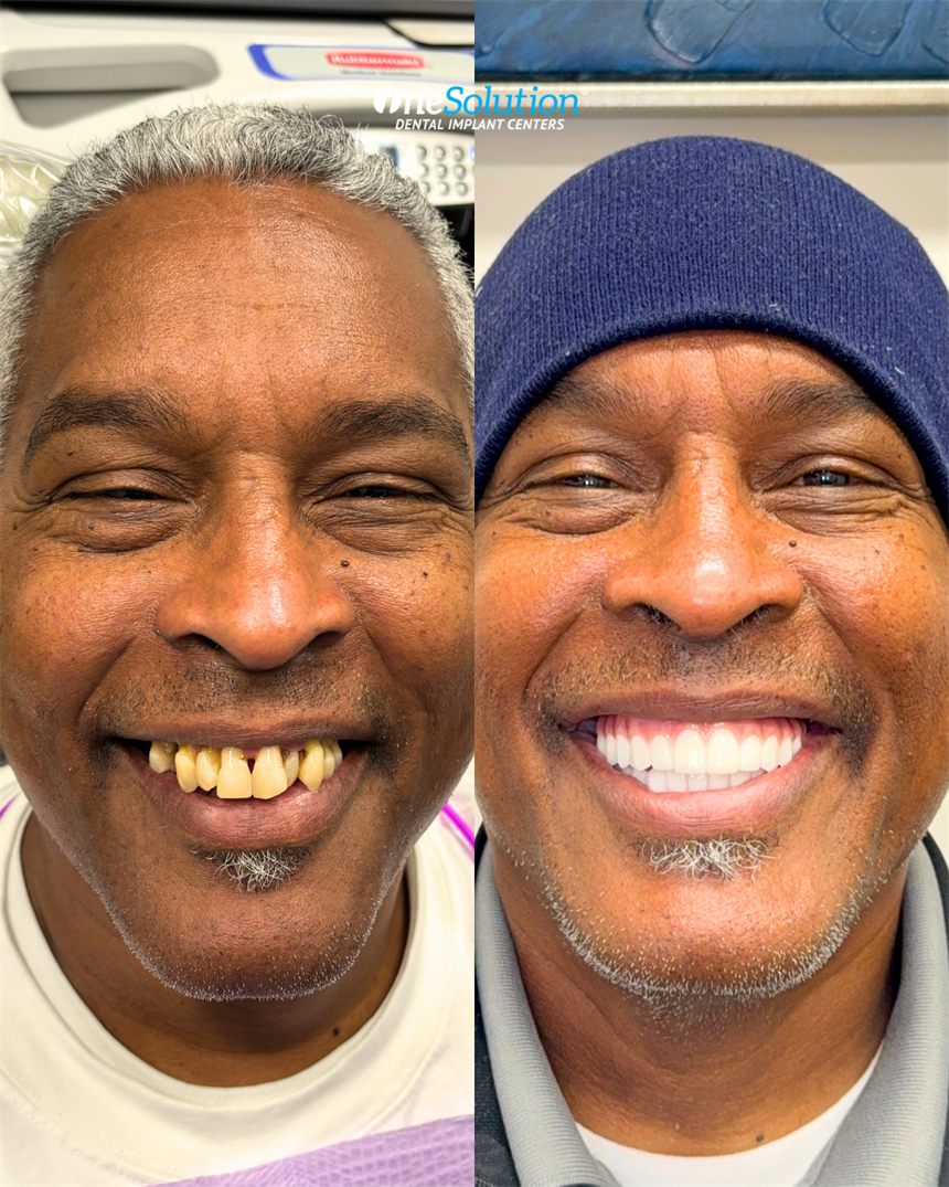 OneSolution® patient before and after dental implants