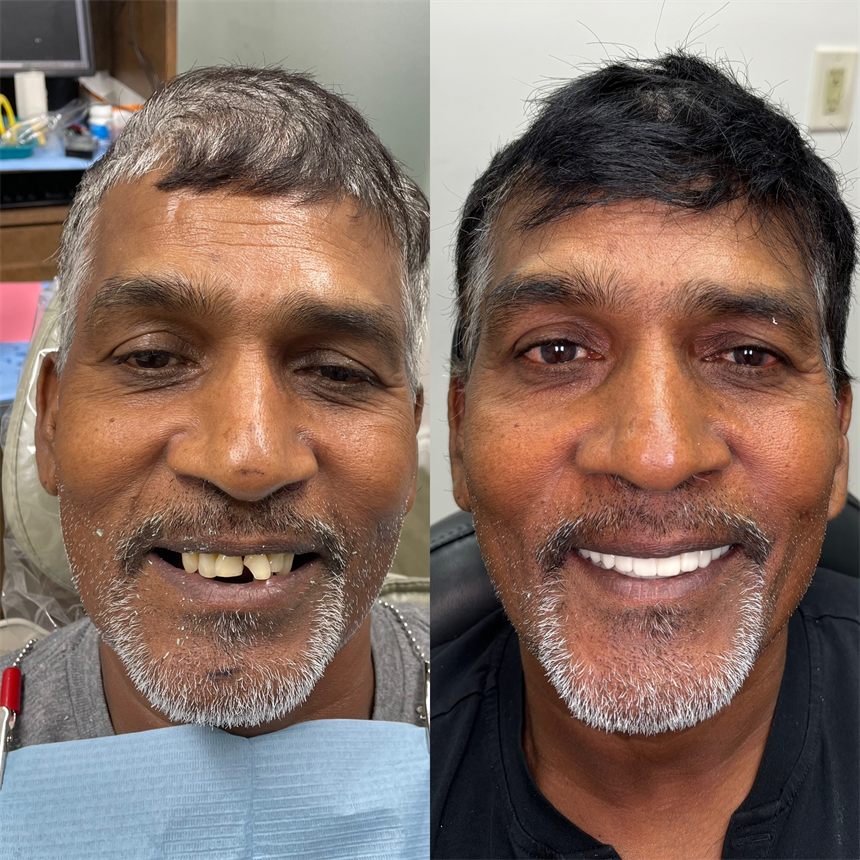 OneSolution® patient before and after dental implants