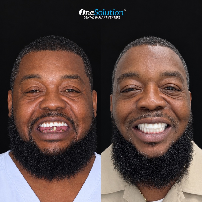 OneSolution® patient before and after dental implants