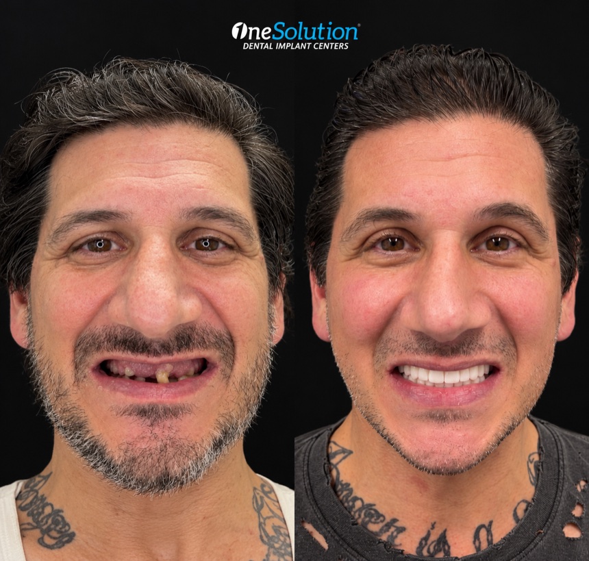 OneSolution® patient before and after dental implants