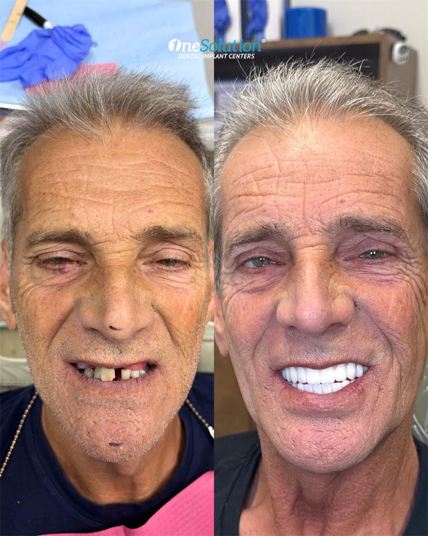 OneSolution® patient before and after dental implants