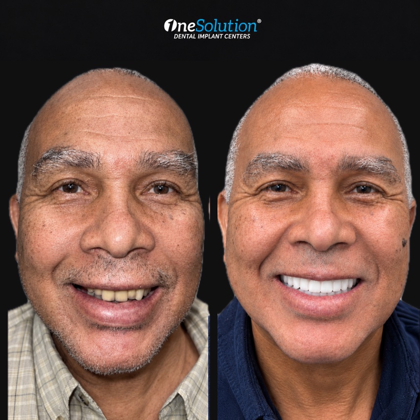 OneSolution® patient before and after dental implants