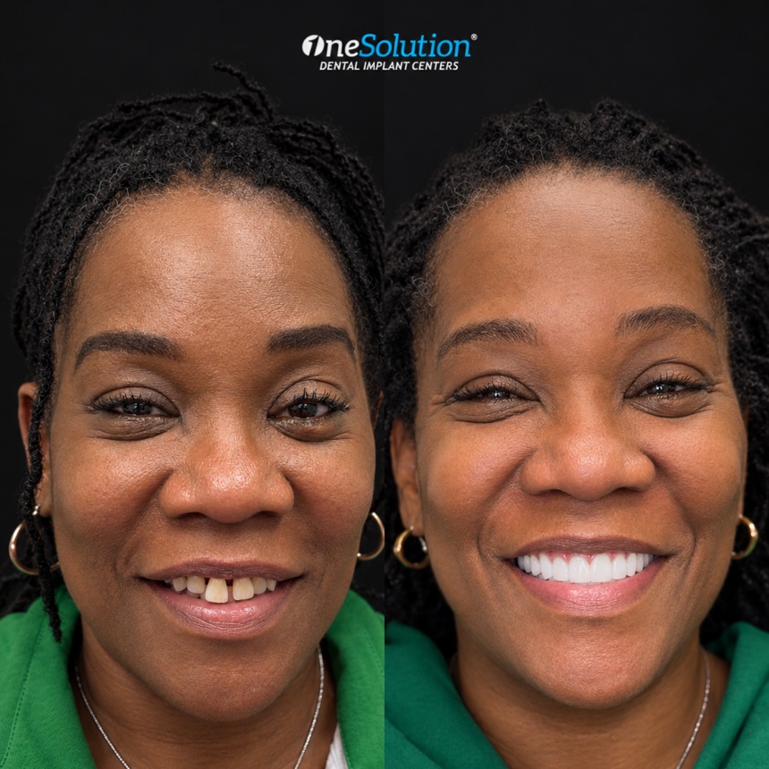 OneSolution® patient before and after dental implants