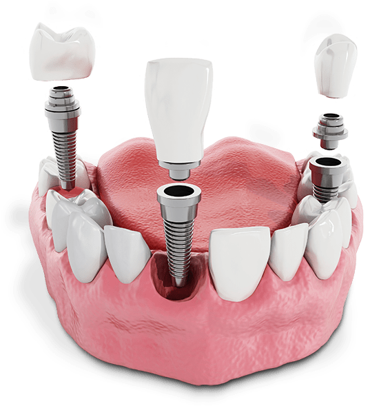 Three single dental implants in a mouth graphic