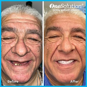 OneSolution® patient before and after 1