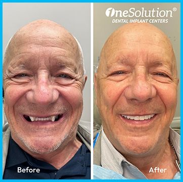 OneSolution® patient before and after 2