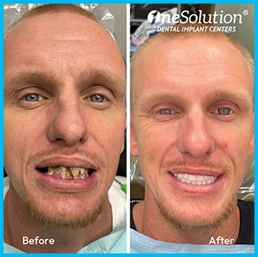 OneSolution® patient before and after 3