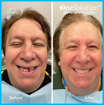 OneSolution® patient before and after 4
