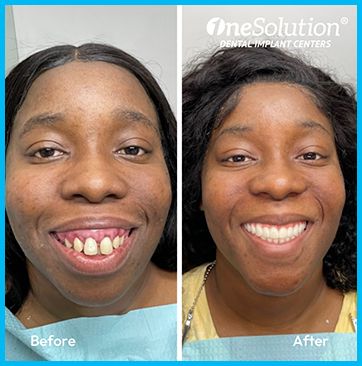 OneSolution® patient before and after 5