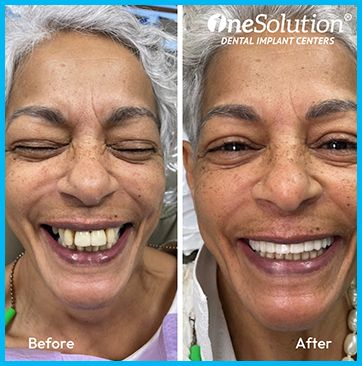 OneSolution® patient before and after 6