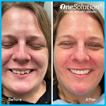 OneSolution® patient before and after 7