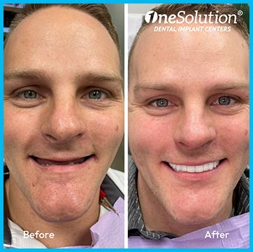 OneSolution® patient before and after 8