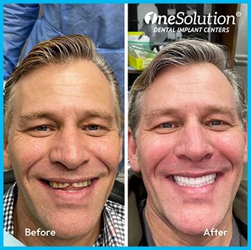 OneSolution® patient before and after 9