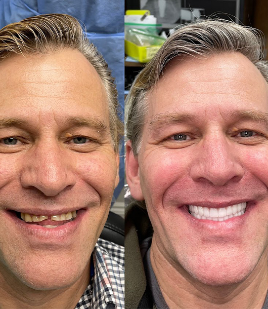 OneSolution® before and after smile transformation