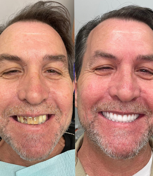 OneSolution® before and after smile transformation