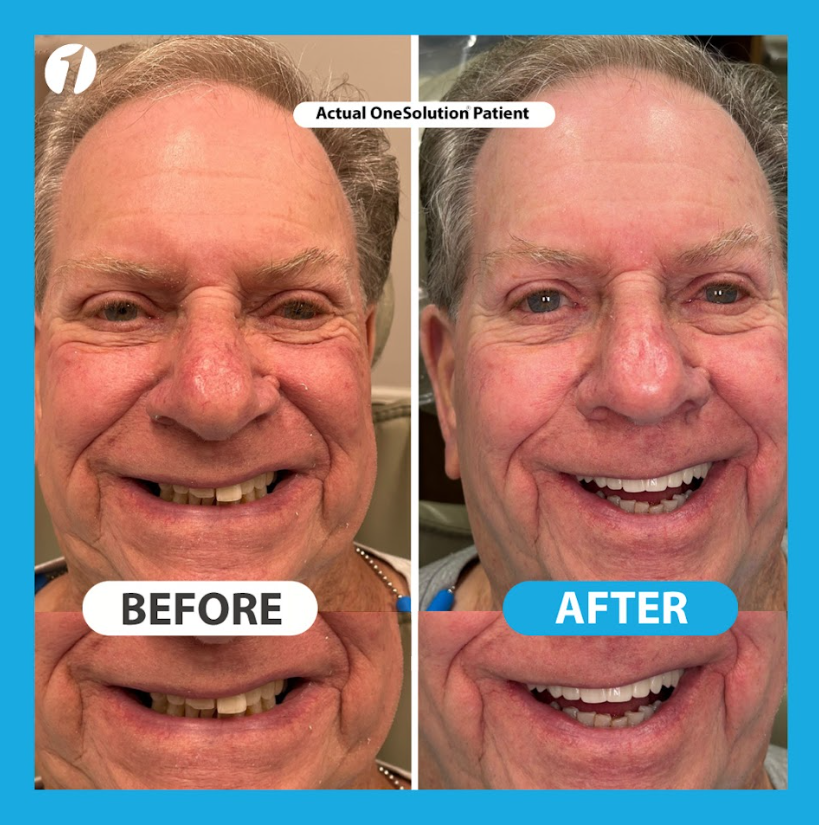 All On 4 Dental Implant Case 2 - OneSolution