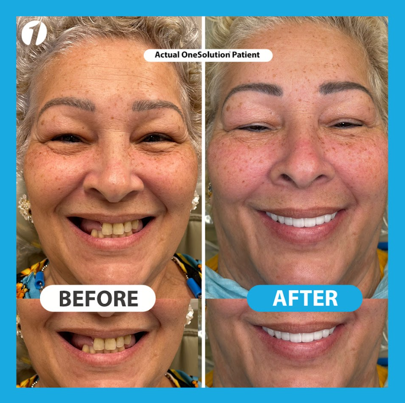 All On 4 Dental Implant Case - OneSolution
