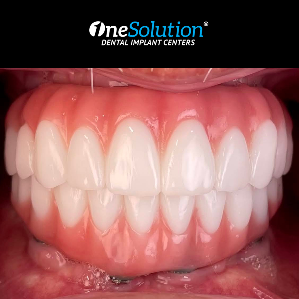 Dental Implants