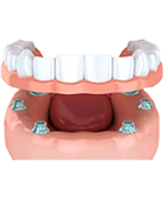 Upper Zyrconia Dental Implants