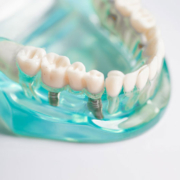 a bunch of single dental implants with crowns on top of the model