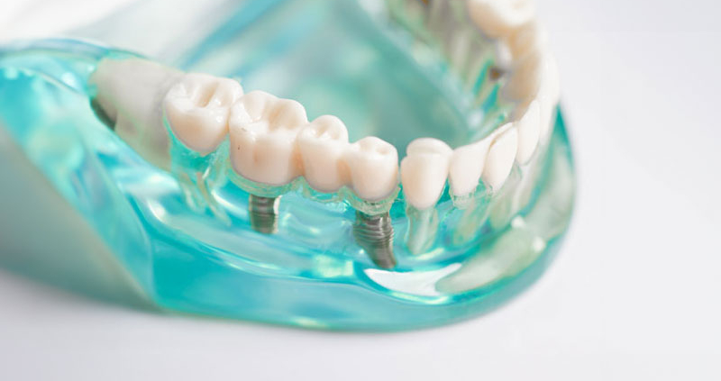 a bunch of single dental implants with crowns on top of the model