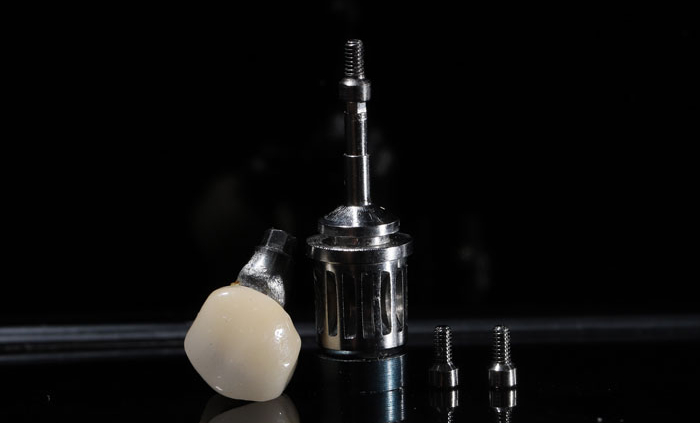 a single dental implant with the abutment and the crown
