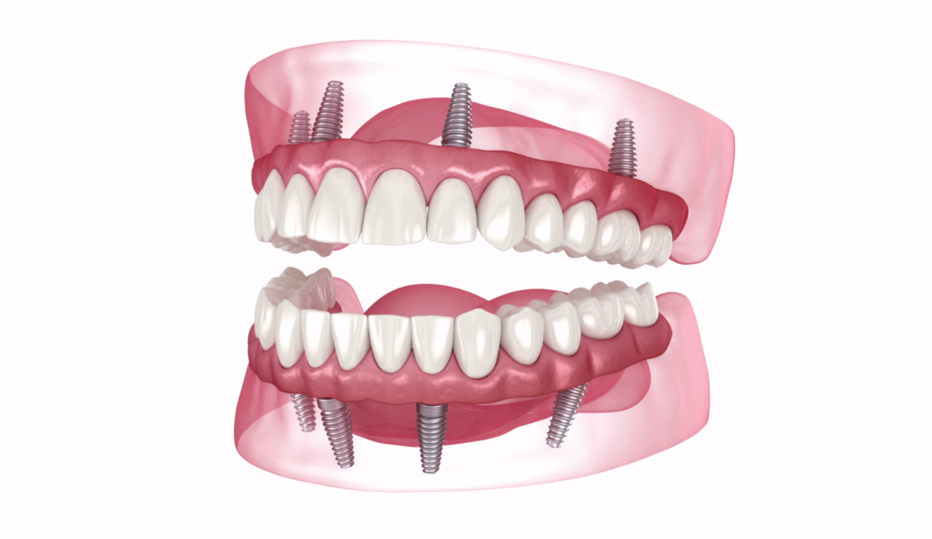 Dental Implants - OneSolution Dental Implant Center