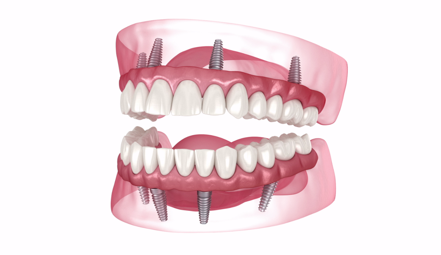 Dental Implants Florida's #1 Center: OneSolution®️ Dental Implants