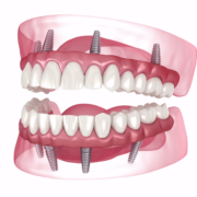 Dental Implants - OneSolution® Dental Implant Center
