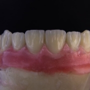 Permanent Dental Implants Example by OneSolution