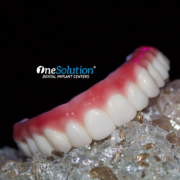 A set of upper teeth of OneSolution® Dental Implant Centers