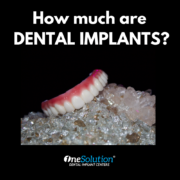 How much are denta implants? By OneSolution® Dental Implant Centers