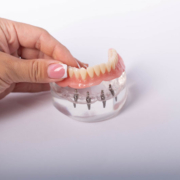 all on 4 dental implants with a full arch of teeth on top of the model