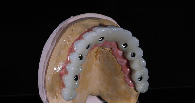 all on x dental implants with a full arch going across the teeth