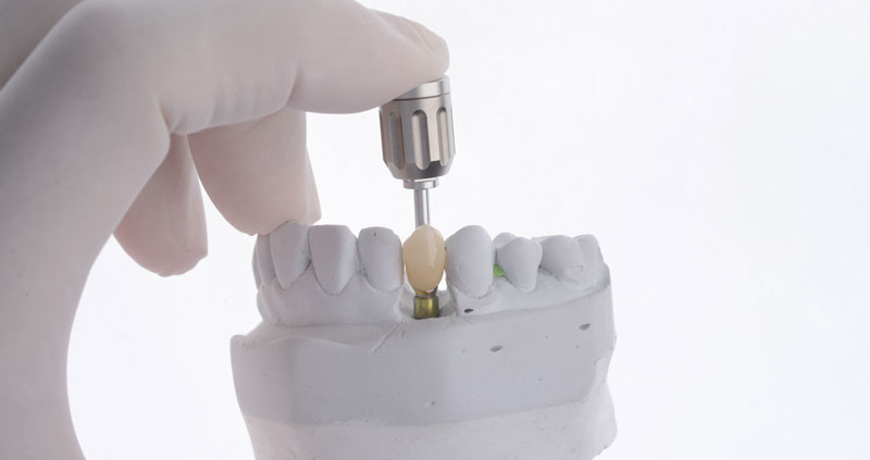 a single dental implant with a doctor holding up the tool piece to show how its place on a model