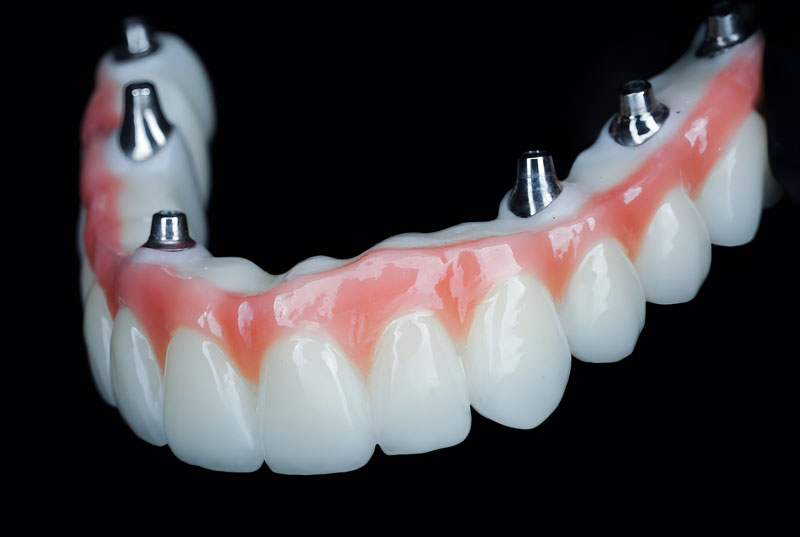 all on 6 dental implants arch with a full zirconia arch