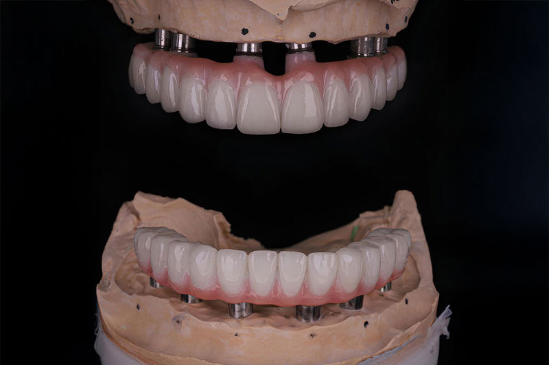 all on x display model with a full arch of teeth