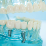 2 single dental implants with a blue jaw model holding it in
