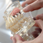 3 single implants with a bone graft holding them onto the jaw