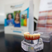 a full arch of teeth with 4 implants across the arch