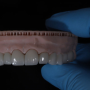 a full arch of teeth with a dentist holding up the model