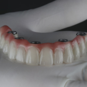 a full arch of teeth with holes for dental implants to be placed into it