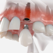 3D illustration of a dental implant with an abutment and crown placement in the upper jaw, showing integration with surrounding teeth and gums."