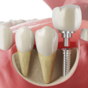3D cross-section illustration of a dental implant with crown placement showing integration with the jawbone and adjacent natural teeth.