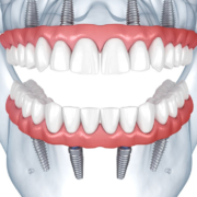 Restore your smile with full mouth dental implants in Riviera Beach, FL. Advanced technology, natural results, and expert care. Schedule your consultation today!