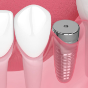3D close-up illustration of a single dental implant post placed in the jawbone with surrounding gum tissue and adjacent natural teeth.