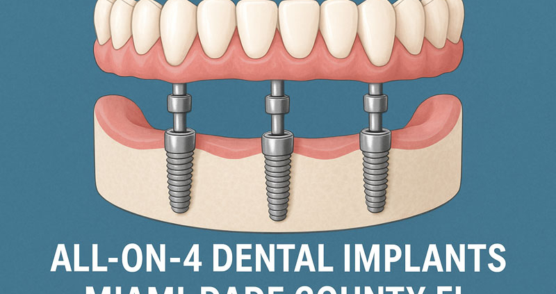 all on 4 dental implants